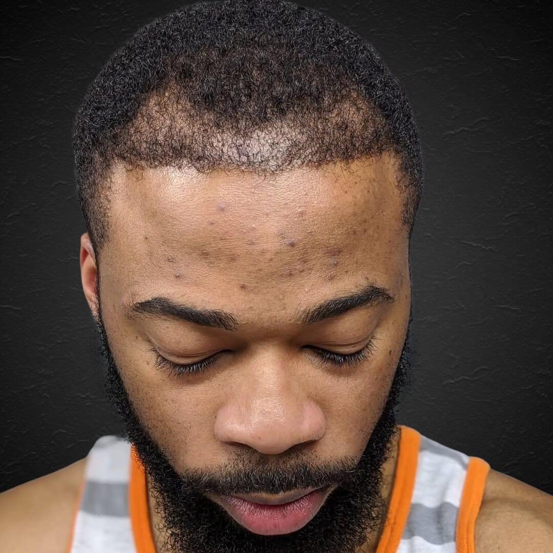 Hair Transplant Design in Tampa - Before and after