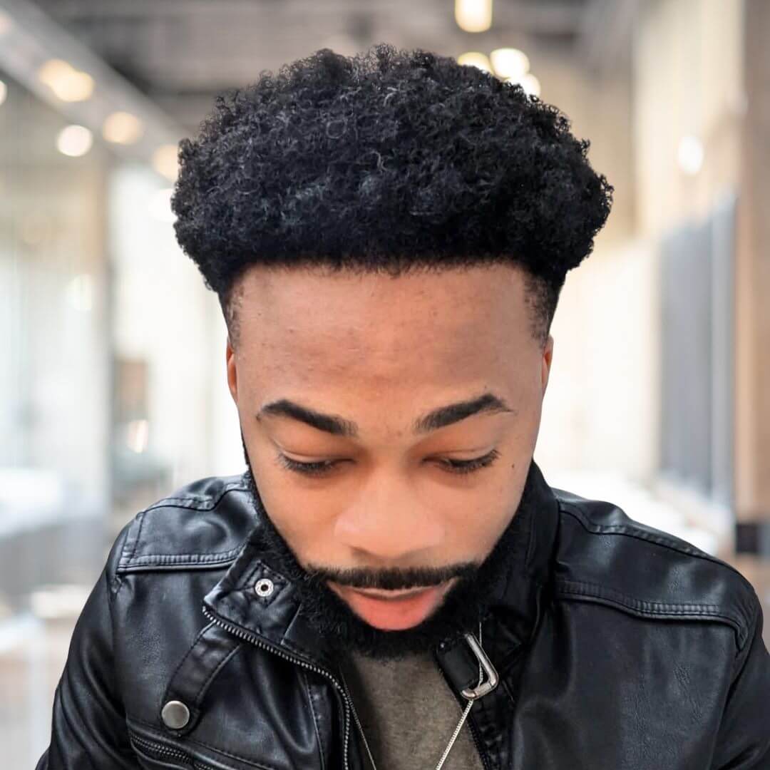 Hair Transplant Design in Tampa - Before and after