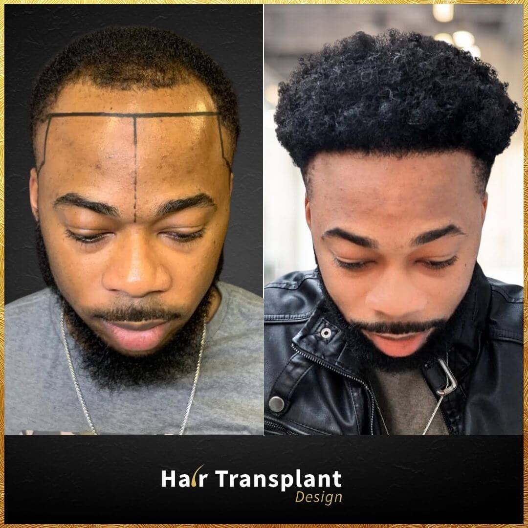 Hair Transplant Tampa - Antes y Despues