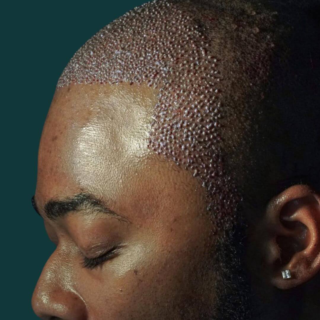 Hair Transplant Design in Tampa - Before and after