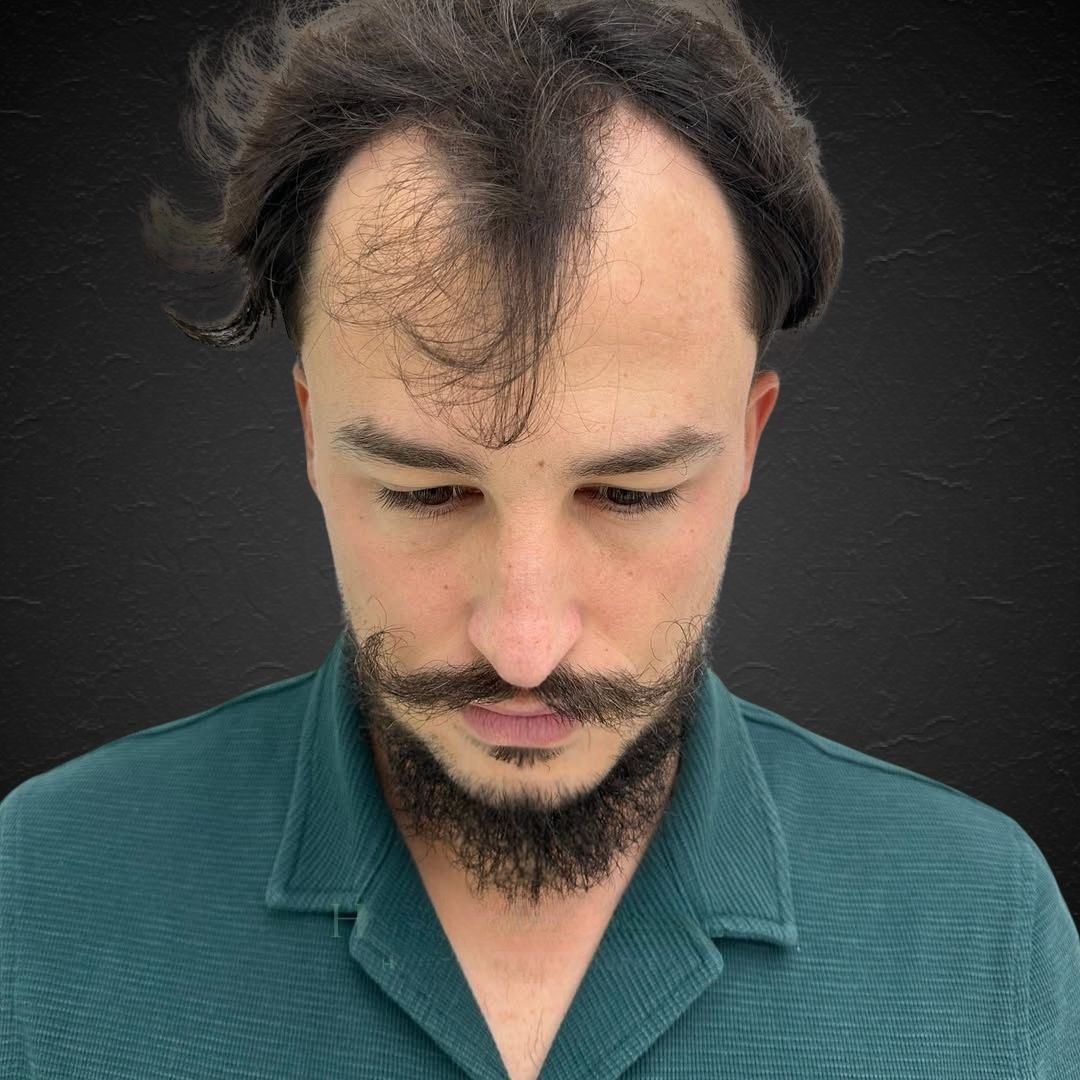 Jorge Before and After - Hair Transplant Design 2