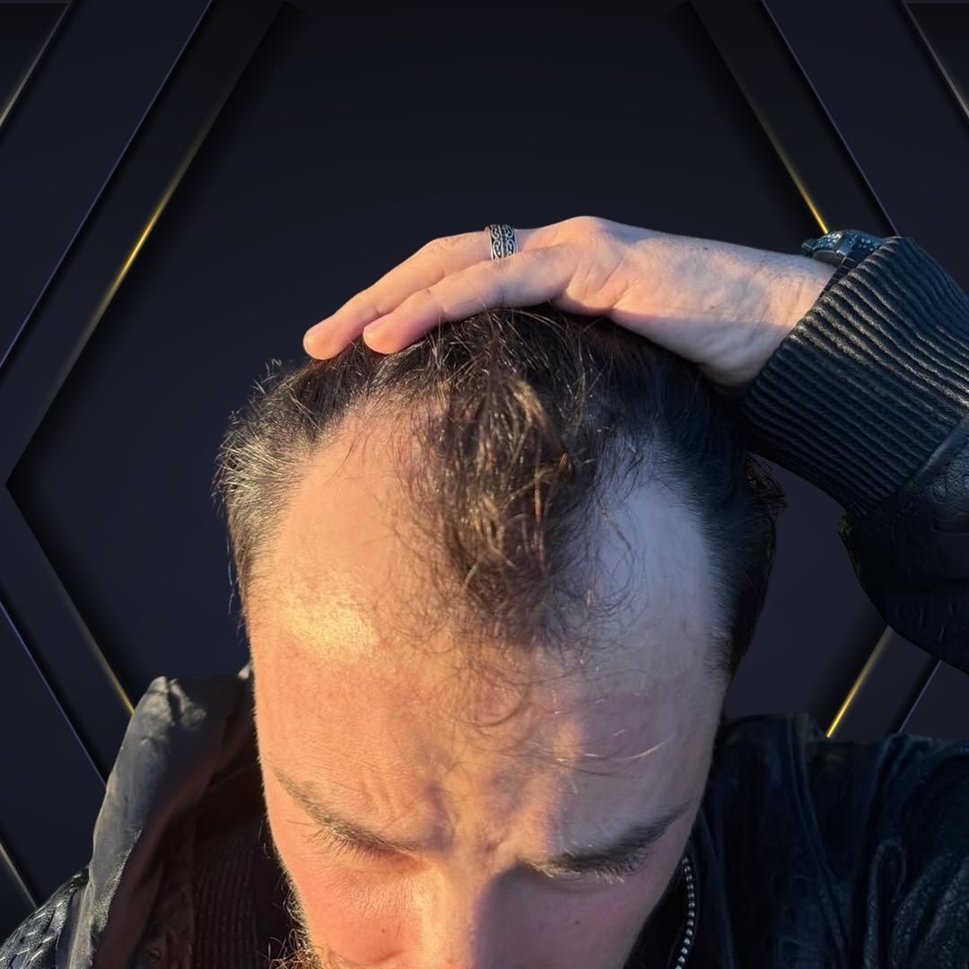 Jorge Before and After - Hair Transplant Design 3
