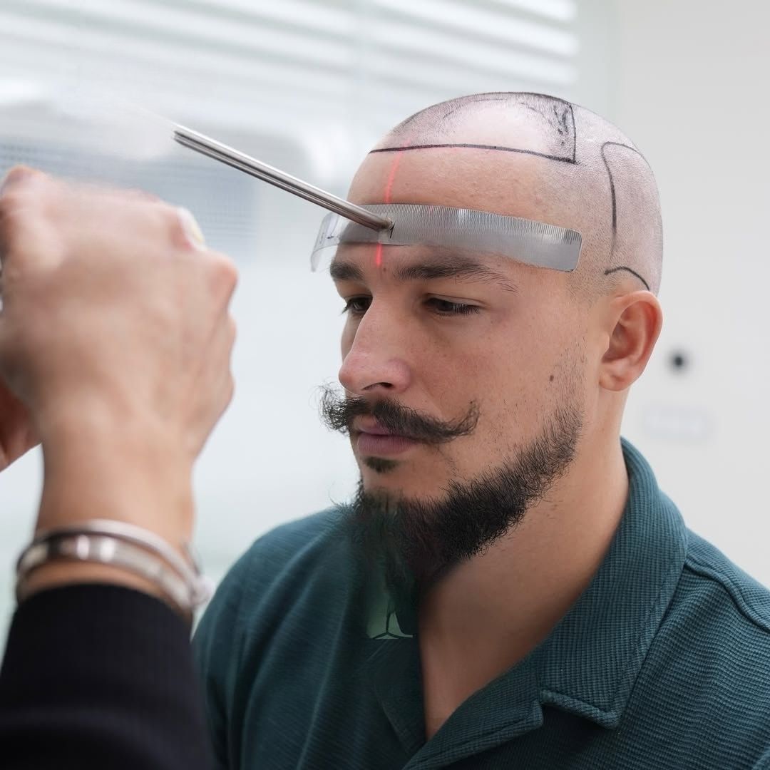 Jorge Before and After - Hair Transplant Design 4