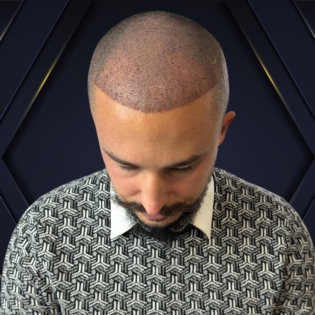 Jorge Before and After - Hair Transplant Design 5