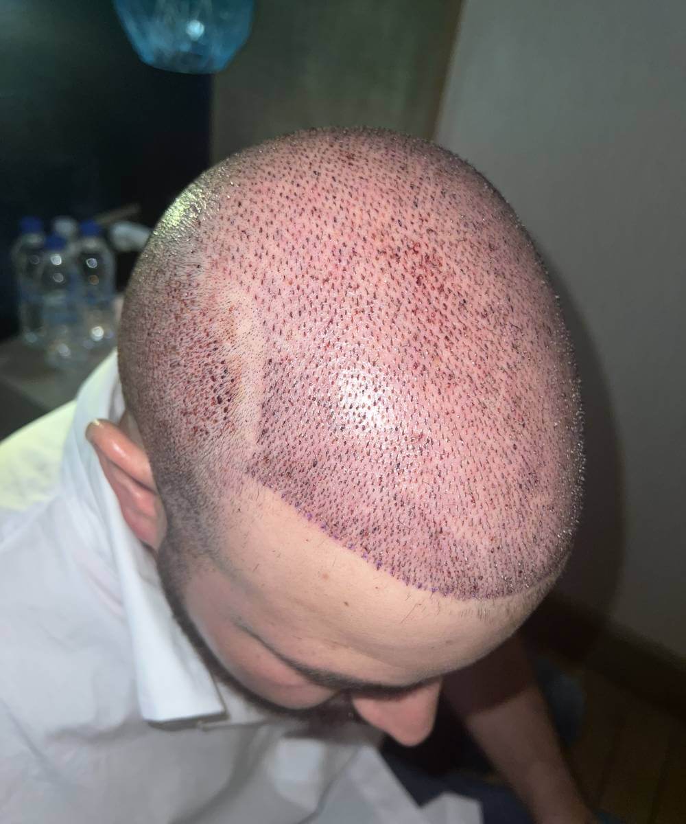 Raul-Hair-Transplant-5800-Foliculos-1