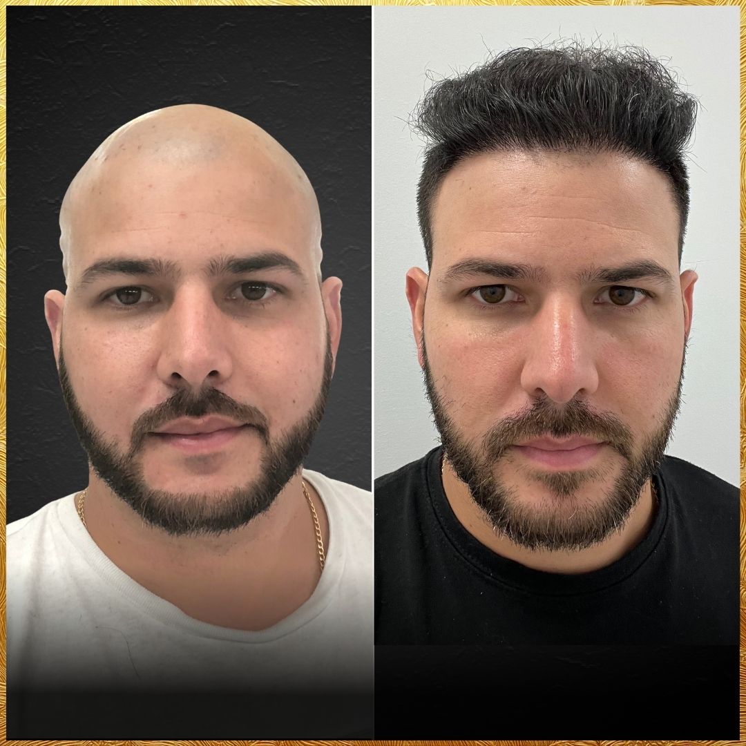 Raul Hair Transplant Design Before and After