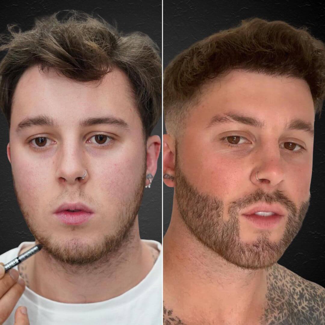 Hair Transplant Design - Beard Before and After